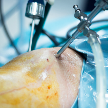 Cirugía Artroscopia de rodilla