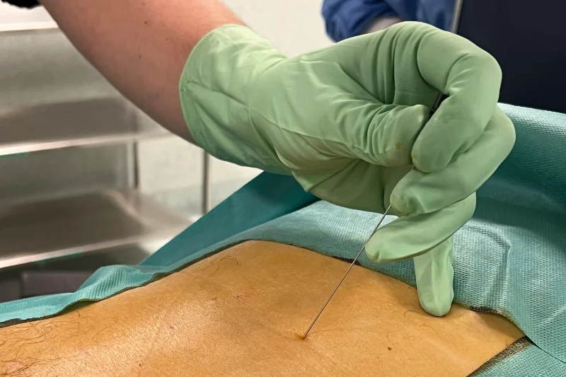 Vista de la parte lumbar durante un intervención para la inserción de plasma rico en plaquetas interdiscal. Se ve una mano de una cirujano con guantes verdes sosteniendo una aguja haciendo una punción sobre la zona lumbar.