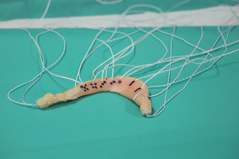 El menisco preparado para ser trasplantado, con las suturas que se hacen para guiar la colocación y fijar en el sitio anatómico. 