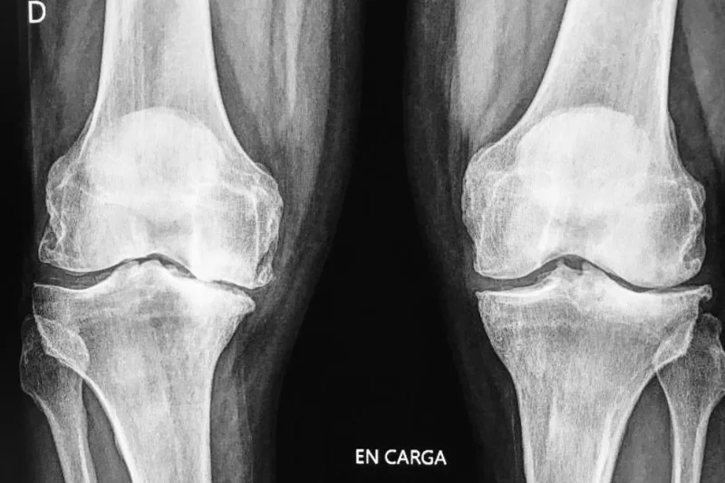 Artrosis de rodilla: nuestro enfoque terapéutico - Instituto Cugat