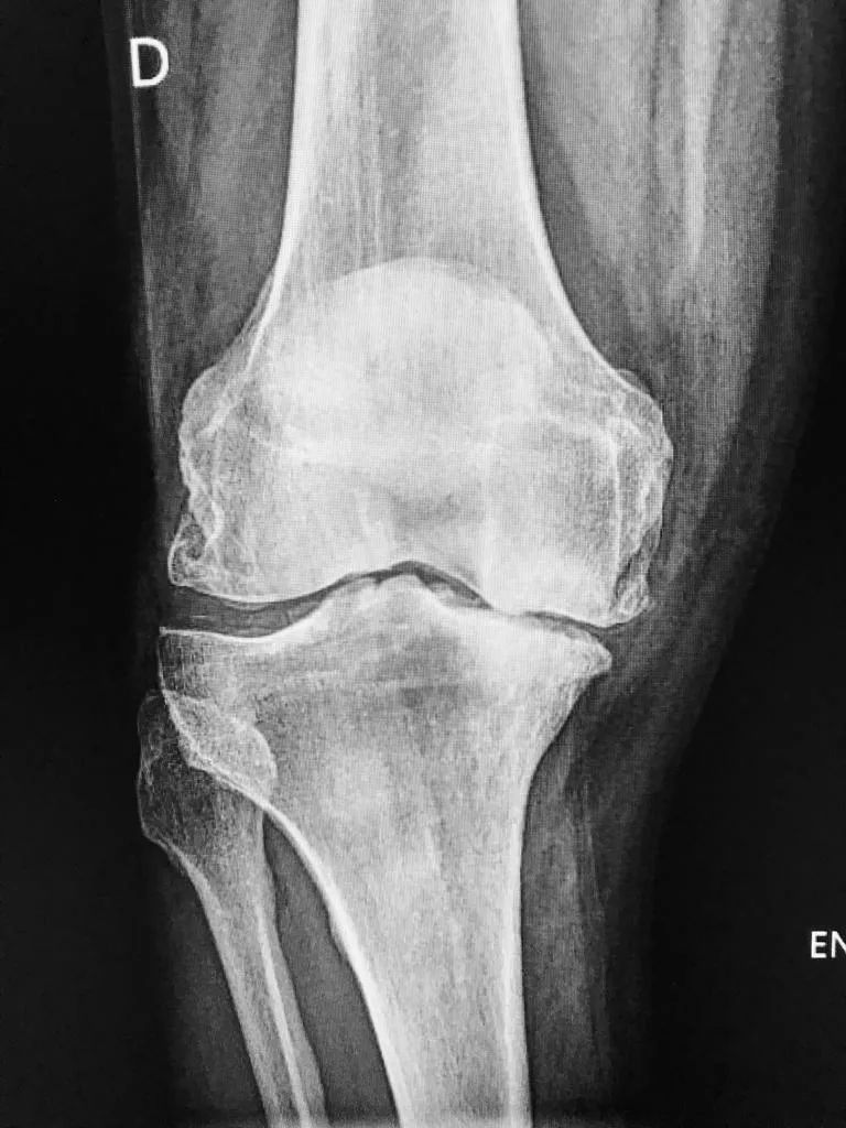 Radiografía de la rodilla derecha donde se ve la rodilla afectada del paciente por la artrosis antes de la operación.