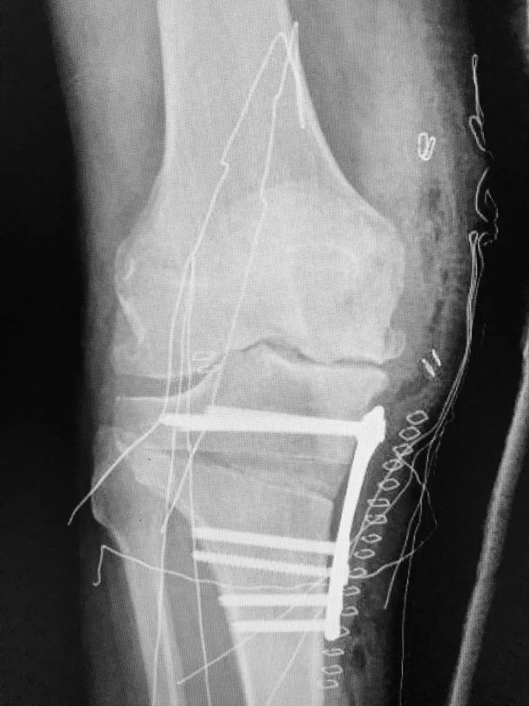 Radiografía de la rodilla justo el día después de llevar a cabo la operación. 