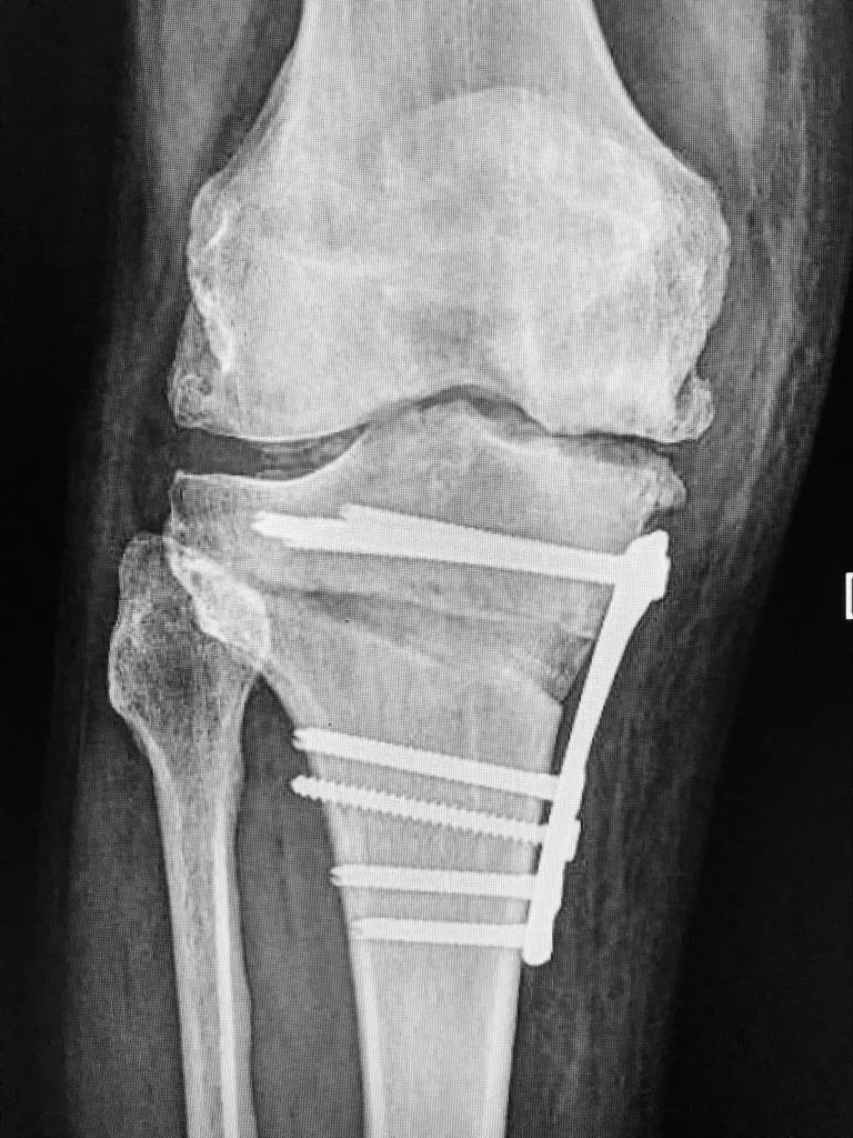 Radiografía de la rodilla seis semanas después de llevar a cabo la operación.