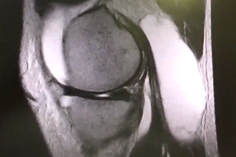 Radiografía de una rodilla en blanco y negro donde se puede observar un quiste de Baker.