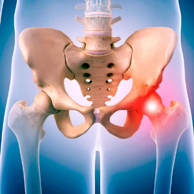Vista frontal de la zona de la cadera en modo radiografía donde puede verse el cartílago de una de las cadera destacado en color rojo
