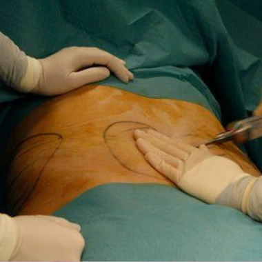 Vista posterior de la parte baja de la espalda de un paciente estirado en una camilla de quirófano en posición prono. Dos médicos de los que solo se ven sus manos están empezando un tratamiento de células regenerativas