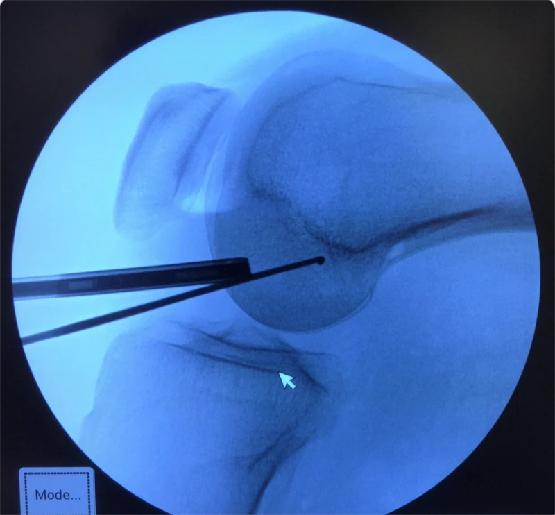 Vista de un radiografía en color azul donde se ve la huella femoral del Ligamento Cruzado Anterior