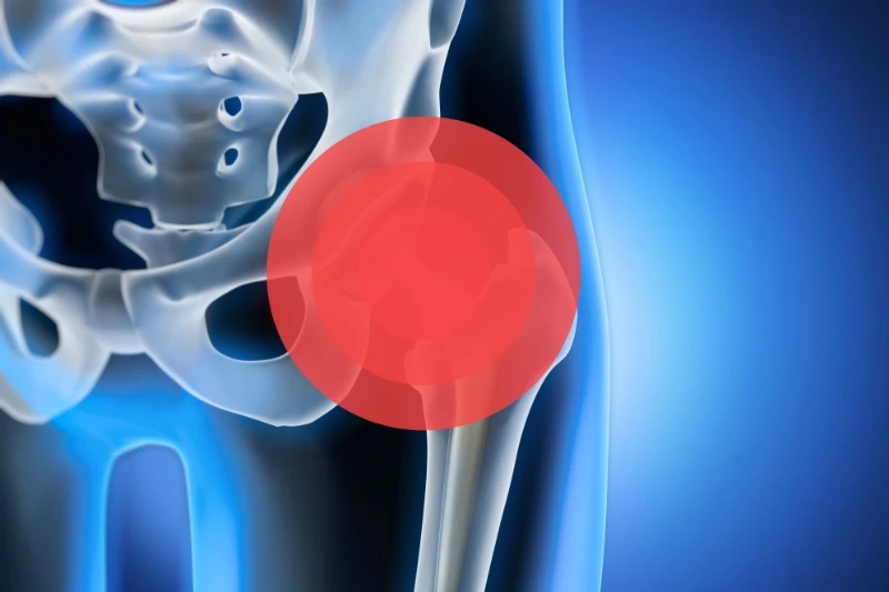 Imagen dibujada de la parte central del tronco donde la zona de la ingle aparece marcada en círculos rojos para resaltar que existe dolor en la ingle.