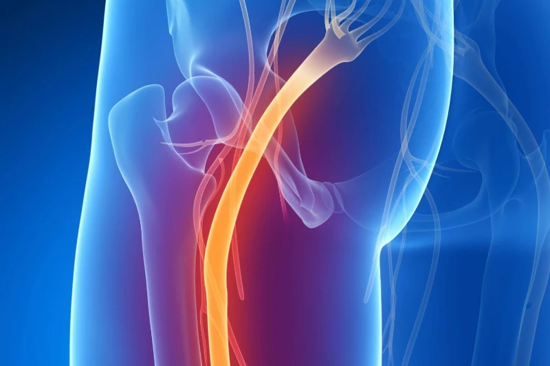 Imagen dibujada en blanco semitransparente sobre fondo color azul donde se ve lateralmente desde la parte central del tronco hasta la parte media del cuádriceps. Donde puede verse el recorrido del nervio ciático marcado en color naranja para resaltar que en esa zona existe dolor.