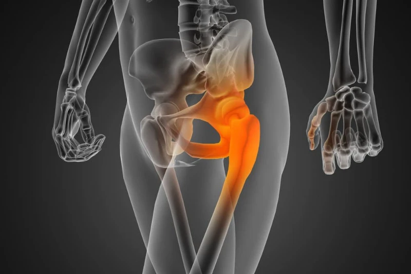 Imagen dibujada de la parte central del tronco donde la zona del trocánter mayor aparece marcada en naranja para resaltar que en esa zona existe inflamación y dolor.