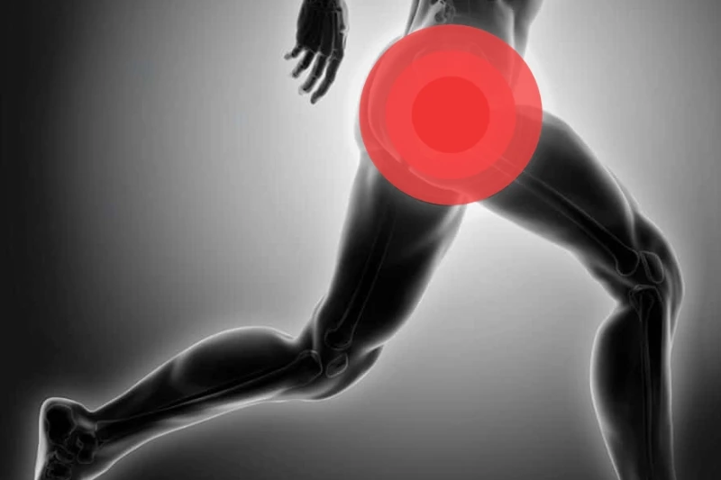 Imagen dibujada de una persona corriendo. Se ve desde casi los pies hasta la parte del tronco. En la zona del glúteo derecho aparece marcada en círculos rojos la zona de la cadera mostrando que existe dolor.