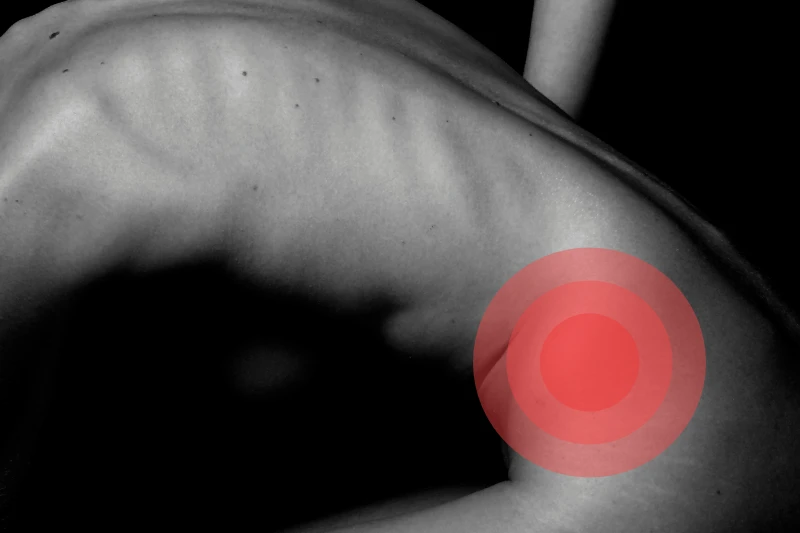 Foto en blanco y negro del torso de una mujer desnuda hasta la zona de la cadera baja. En posición lateral, flexionada y en donde una zona roja marca la zona de la cadera izquierda que queda frente a la cámara para resaltar dolor en esa zona.