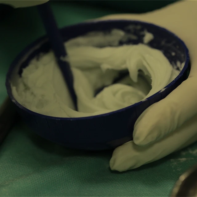 Unidad protesis – como es la cirugía Detalle de una mano con guante blanco de cirujano sosteniendo un pequeño recipiente azul donde se mezcla con una espátula una sustancia o cemento óseo de consistencia pastosa y color blanco.