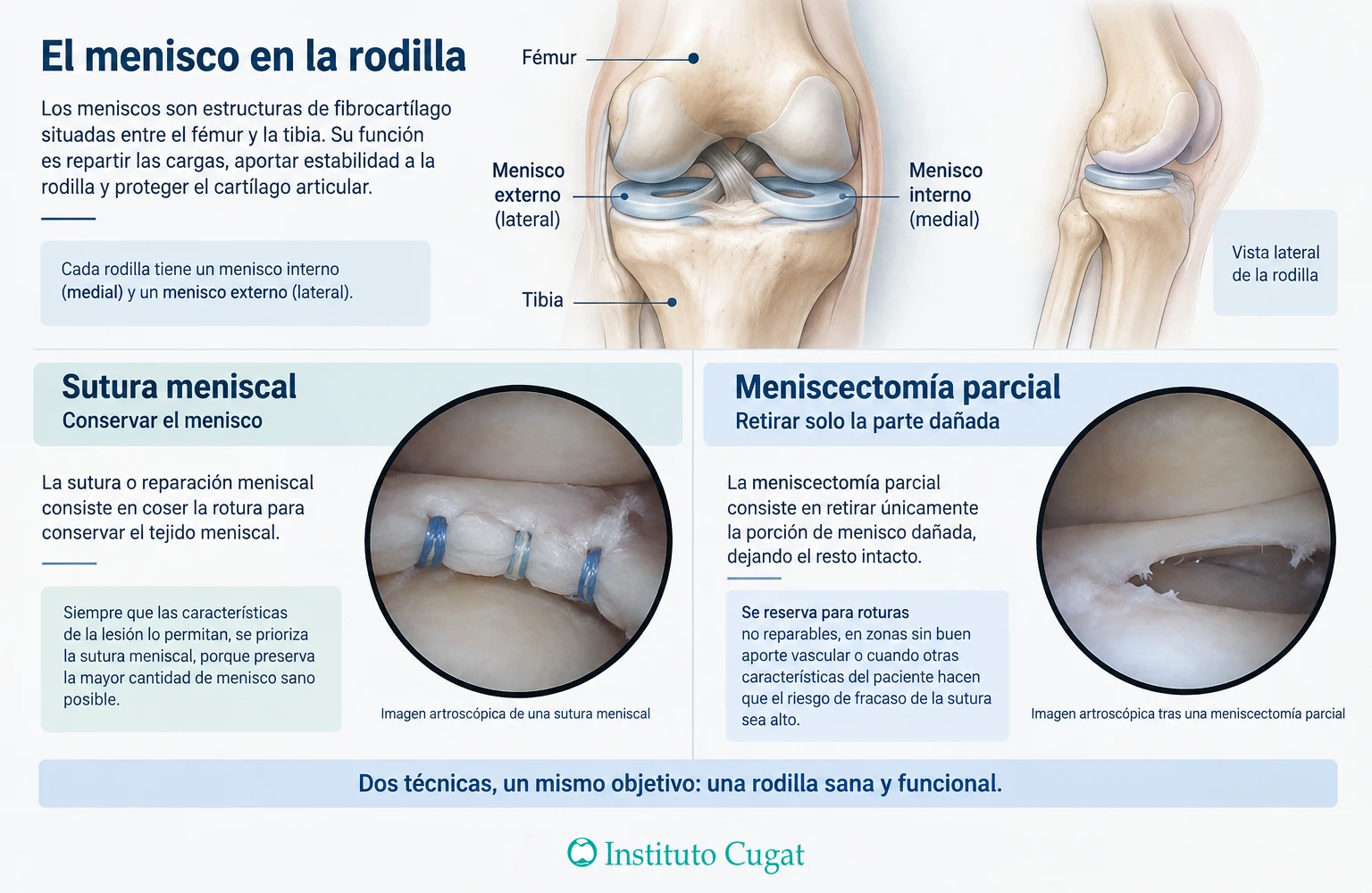 Esquema comparativo de la sutura meniscal y la meniscectomía parcial, con la anatomía del menisco y las diferencias entre ambas técnicas.